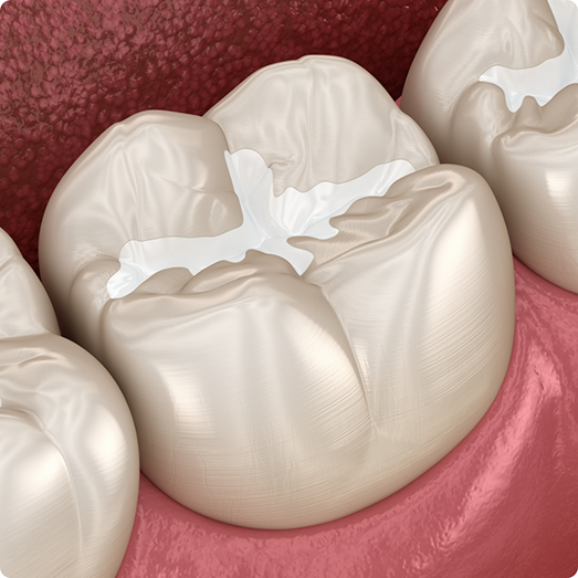 Illustration of teeth with dental sealants