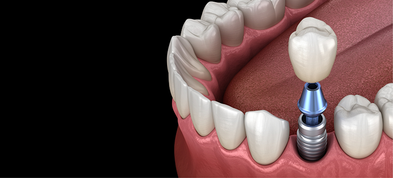 Illustration of a single dental implant