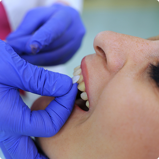 Dental patient having a veneer placed over their tooth