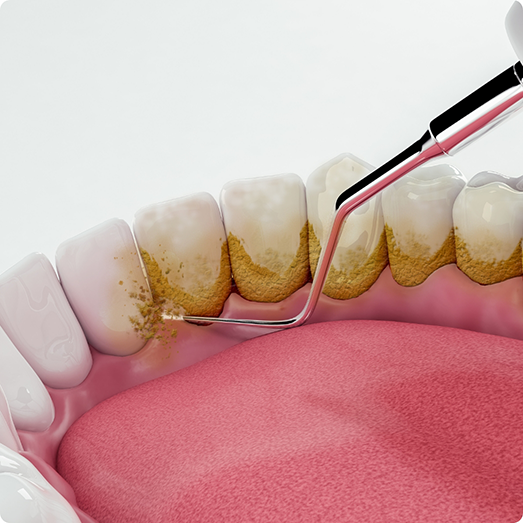 Illustration of scaling and root planing on lower teeth