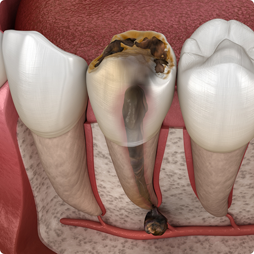 Illustration of an infected tooth