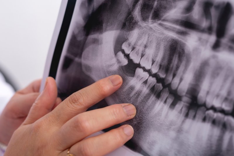 A dental x-ray highlighting a patient’s missing molar